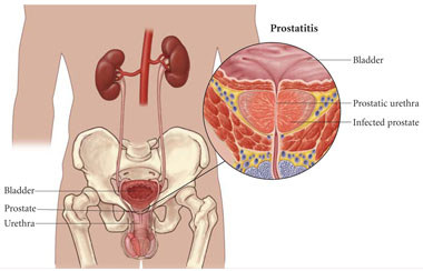 adenom de prostată la un bărbat în vârstă medicamente și preparate pentru tratamentul adenomului de prostată
