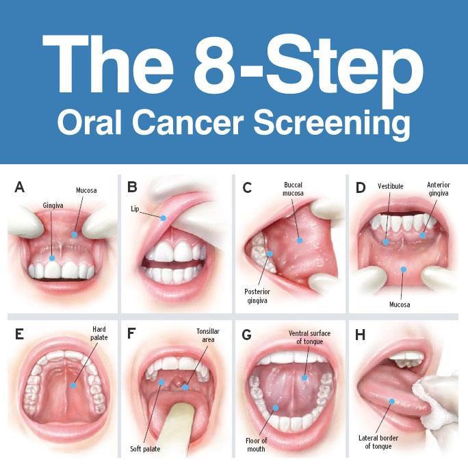 Oral-Cancer-Screening