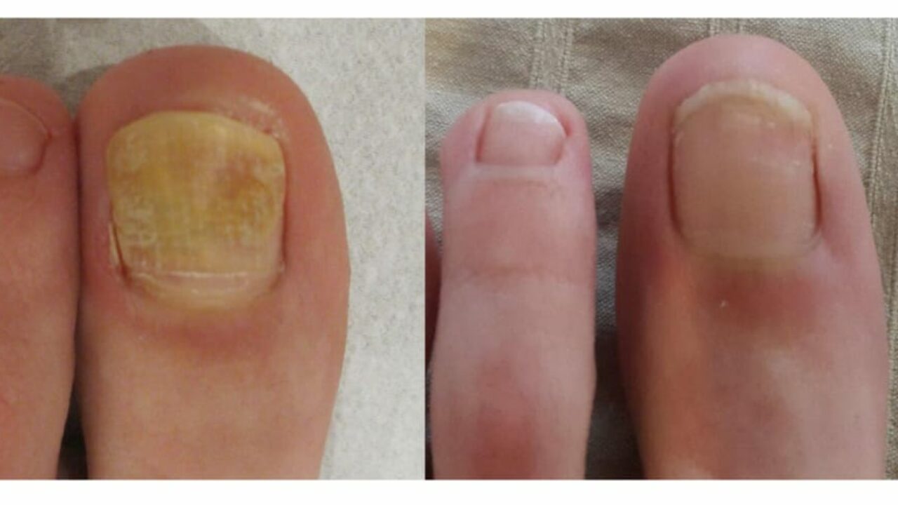 ciuperca unghiilor de la picioare ajută la vindecare