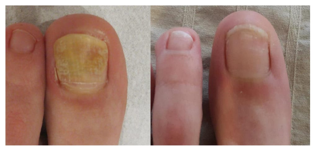 îndepărtarea cu laser a unghiei de la picior afectată de ciuperca de pe picior